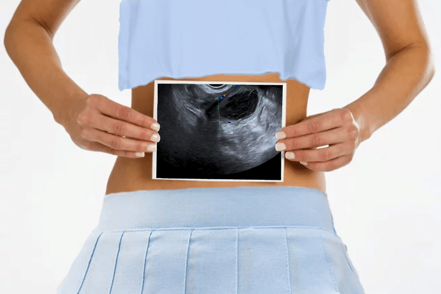 Alta precisión de la ecografía transvaginal para endometriosis del ligamento uterosacro