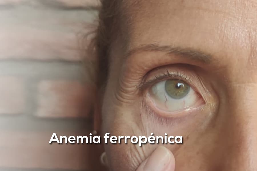 Anemia ferropénica en mujeres: riesgo muy superior al de los hombres