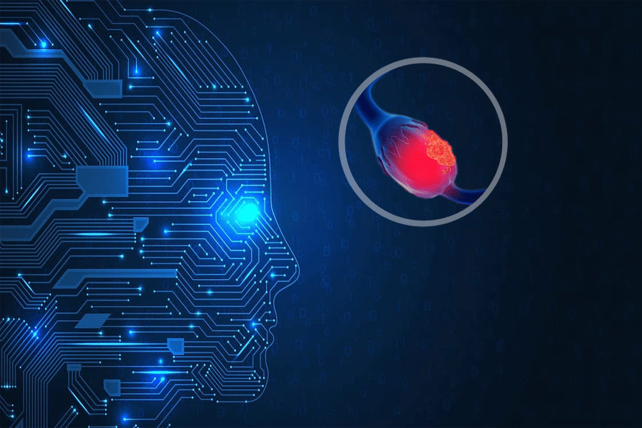 Cáncer de ovario la Inteligencia Artificial ayudará a mejorar el tratamiento
