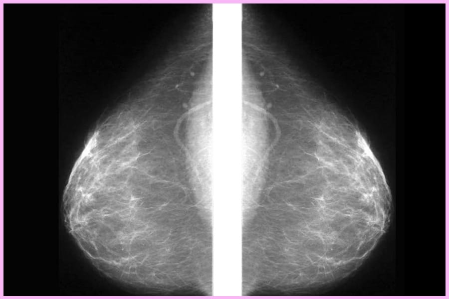Diagnóstico del cáncer de mama mediante corrientes eléctricas de bajo voltaje