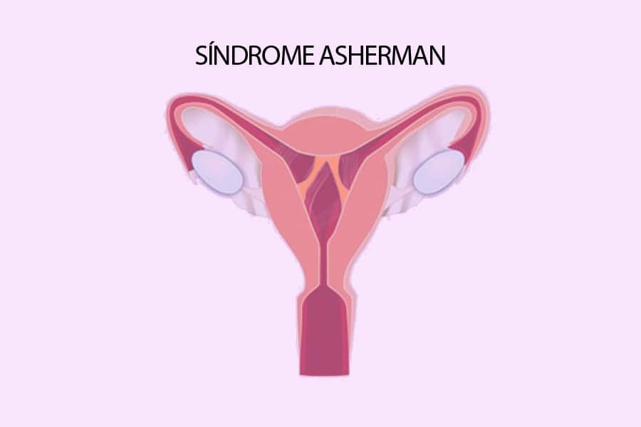 El síndrome de Asherman y su impacto sobre la fertilidad copia