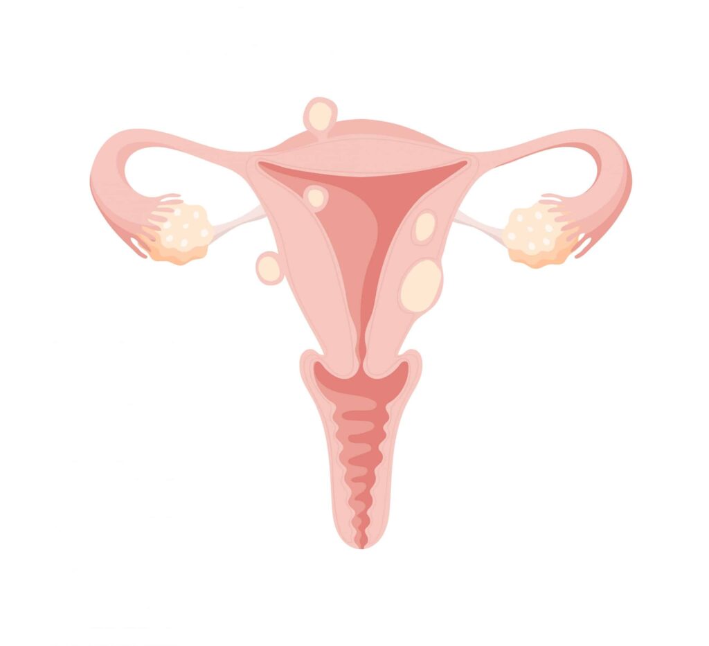 Miomas uterinos y sustancias tóxicas en productos de uso diario