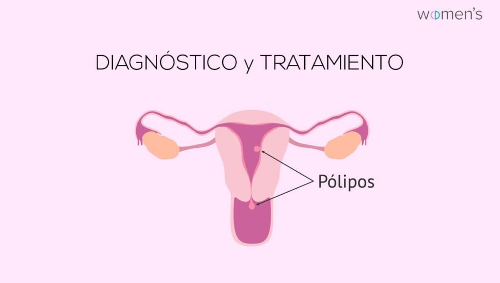 Pólipos endometriales diagnóstico y tratamiento. Dibujo de situación de los pólipos