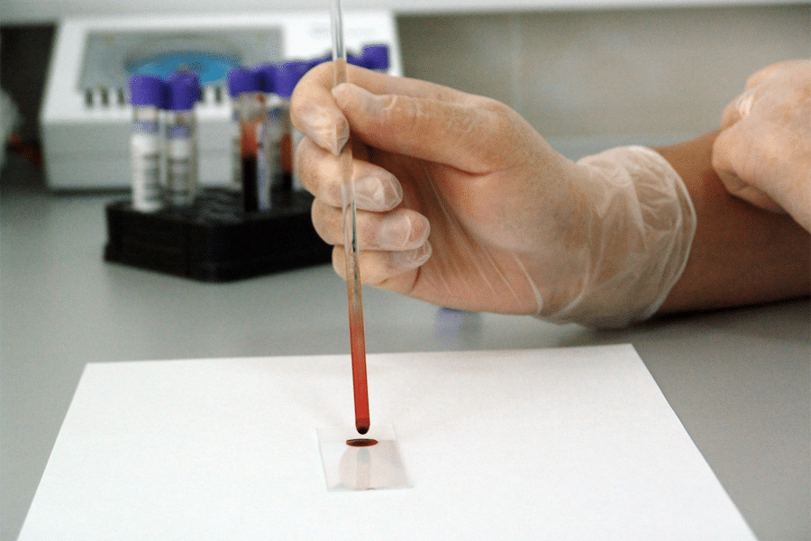 Preeclampsia un análisis de sangre permitirá predecir la enfermedad antes de que aparezca