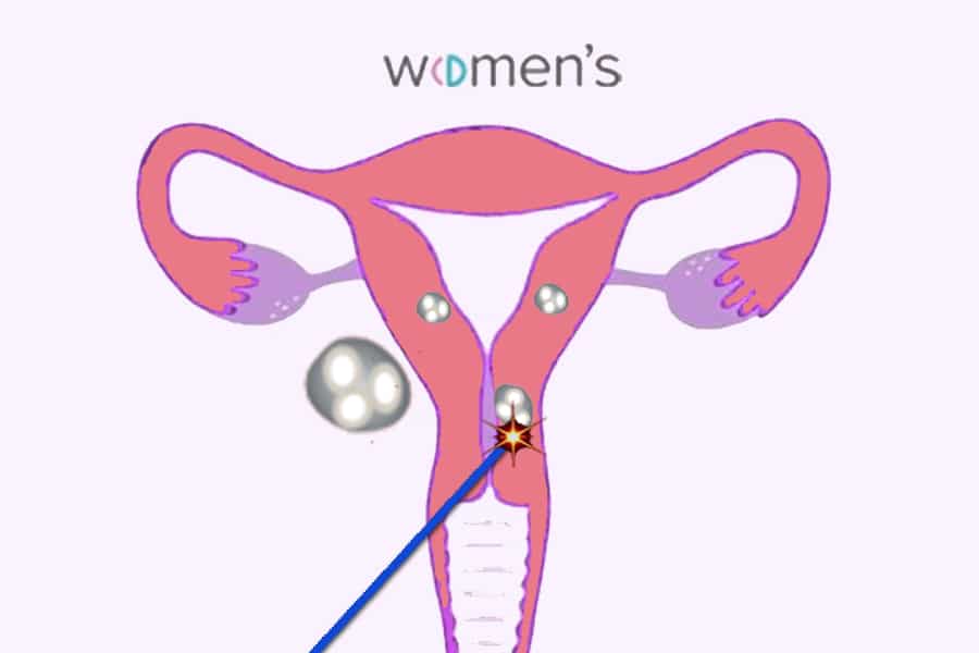 Radiofrecuencia para el tratamiento de los miomas uterinos