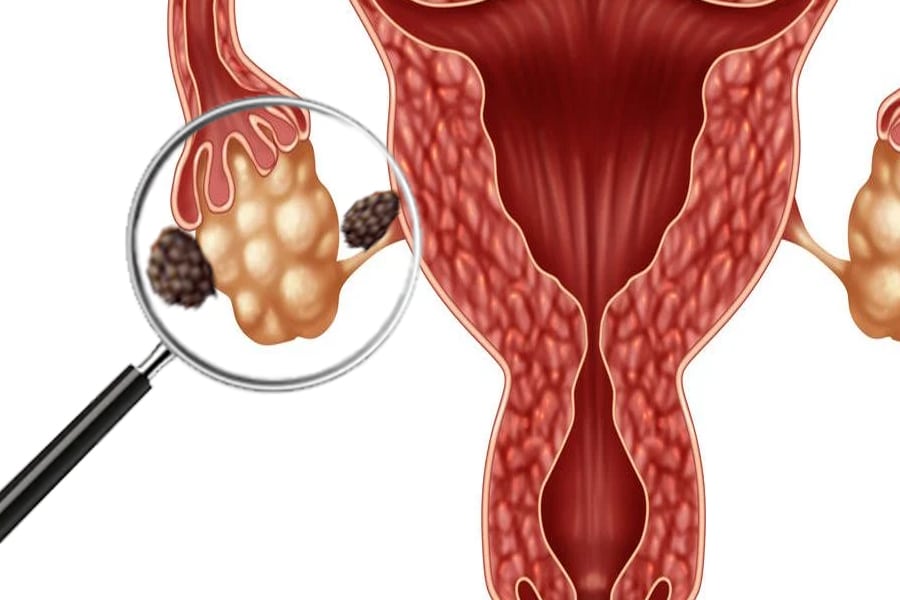 Vínculo genético entre la endometriosis y el cáncer de ovario